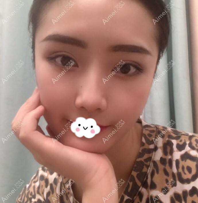 广州积美双眼皮怎么样？福田庆三案例了解