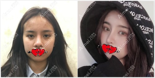 杭州艺星整形张龙医生肋骨鼻案例一年效果对比图