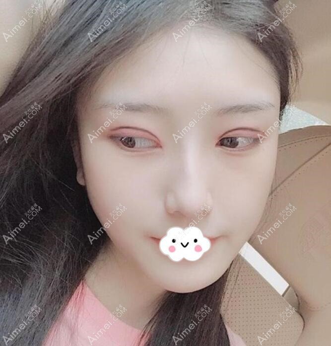 广州积美福田庆三双眼皮+开眼角+去眼袋案例