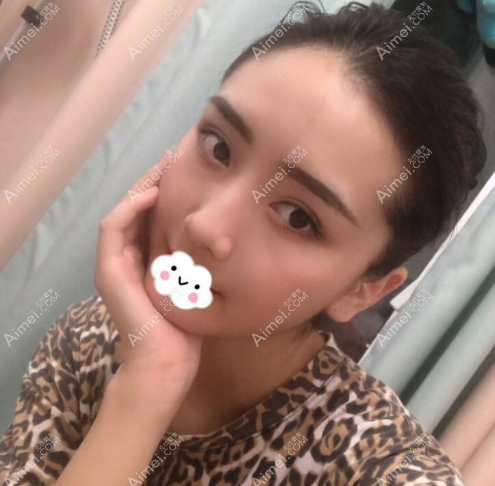 广州积美眼综合术后15天恢复过程图
