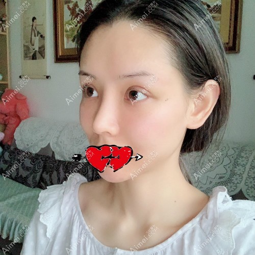 去杭州艺星找张龙医生做肋骨鼻术后第15天照片 去杭州艺星找张龙医生做肋骨鼻术后第15天照片