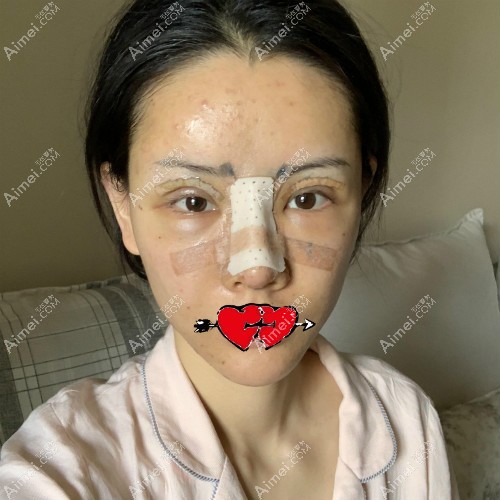 杭州整形医生张龙隆鼻案例:肋骨鼻术前素颜照片 杭州整形医生张龙隆鼻案例:肋骨鼻术前素颜照片