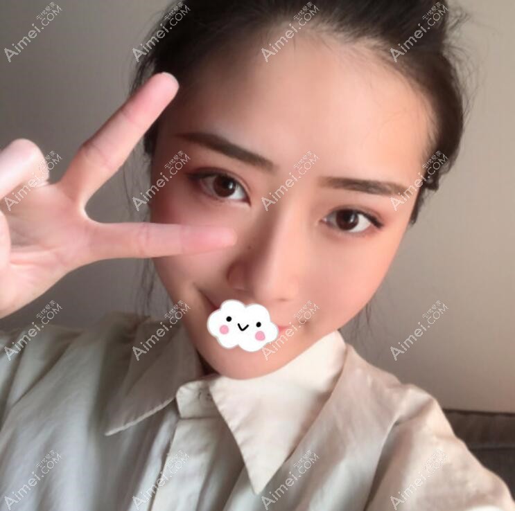 广州积美双眼皮+开内眼角+去眼袋案例术后恢复图