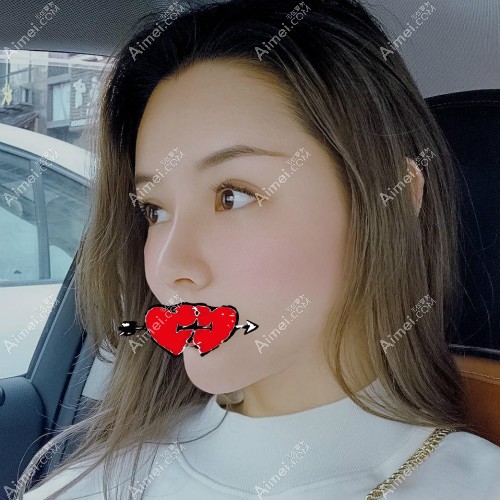 杭州有名的隆鼻医生张龙隆鼻案例:半肋骨鼻术后一个月效果 杭州有名的隆鼻医生张龙隆鼻案例:半肋骨鼻术后一个月效果