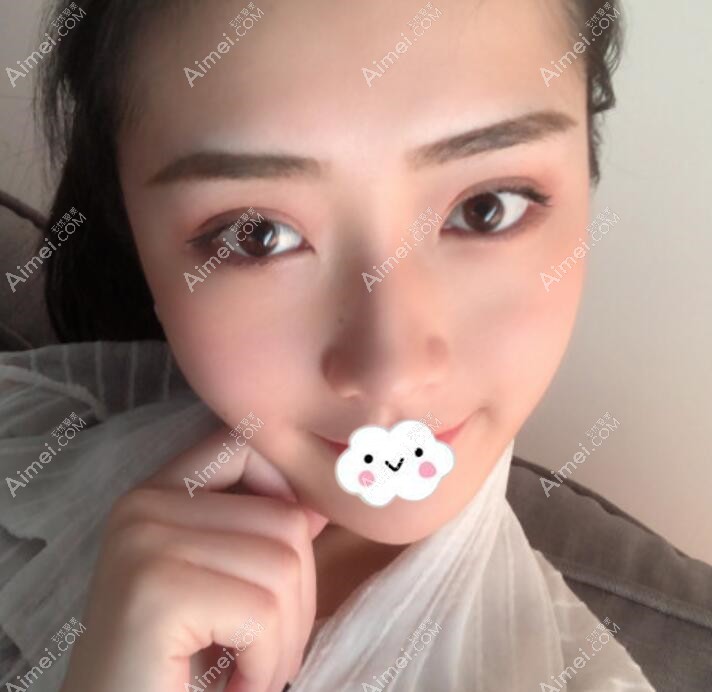 日本福田庆三医生双眼皮+开内眼角+去眼袋案例图