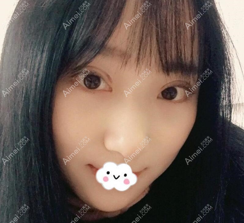 广元割双眼皮哪里好?广元朗睿双眼皮案例 广元割双眼皮哪里好?广元朗睿双眼皮案例