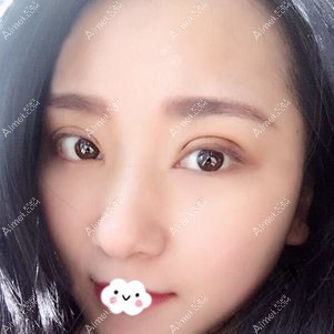 四川广元全切双眼皮术后三天效果图 四川广元全切双眼皮术后三天效果图