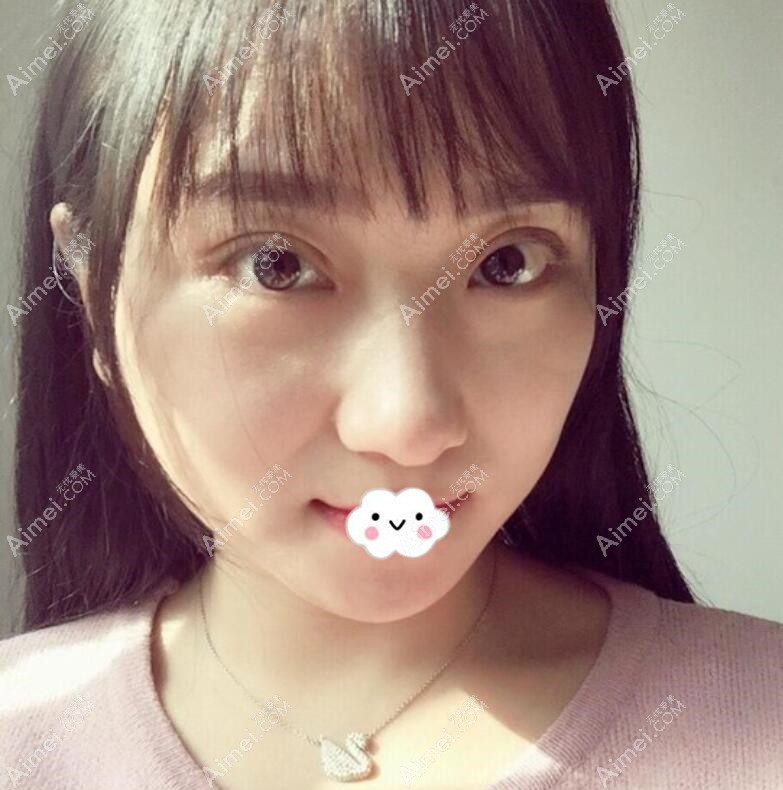做双眼皮多久能恢复好?这是我术后10天效果图 做双眼皮多久能恢复好?这是我术后10天效果图