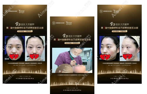 杭州yestar欧阳帆双眼皮案例效果对比图 杭州yestar欧阳帆双眼皮案例效果对比图