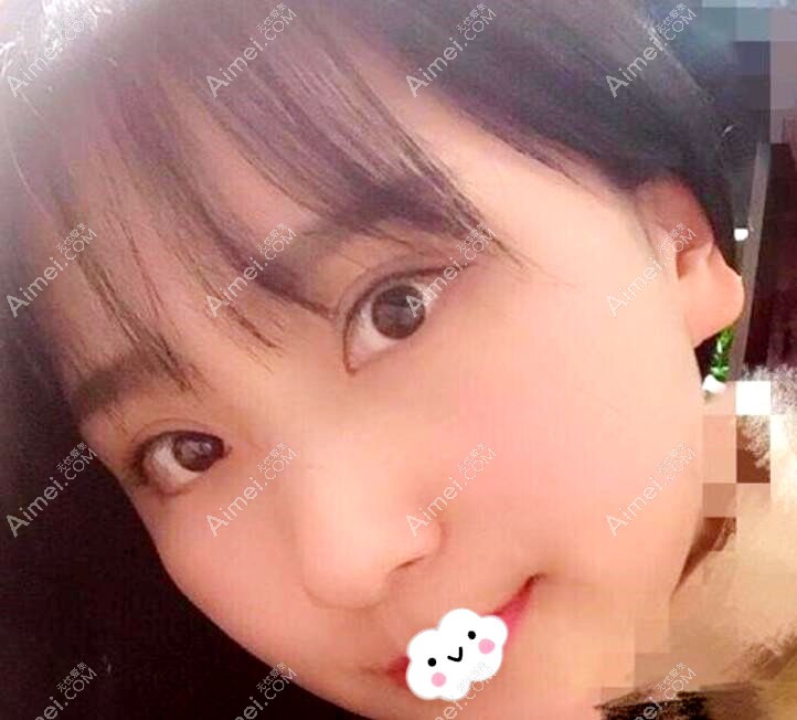 2个月效果图大家看广元朗睿做双眼皮怎么样 2个月效果图大家看广元朗睿做双眼皮怎么样