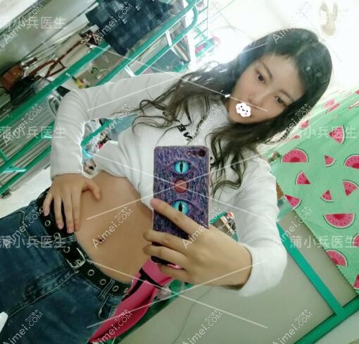 成都军大医院蒲小兵腰腹吸脂案例 成都军大医院蒲小兵腰腹吸脂案例