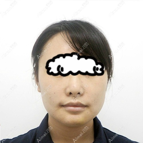 找杭州瑞丽何涛做5g光雕面部吸脂术后第2天效果 找杭州瑞丽何涛做5g光雕面部吸脂术后第2天效果