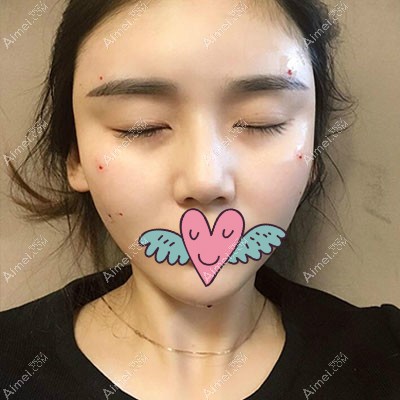 全脸脂肪填充第1天恢复照片 全脸脂肪填充第1天恢复照片