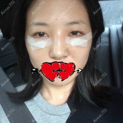 在金华亚美做内路祛眼袋术后第1天照片 在金华亚美做内路祛眼袋术后第1天照片