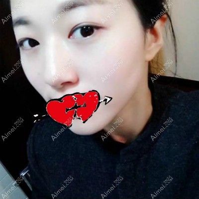 在金华亚美做内路祛眼袋术后18天效果 在金华亚美做内路祛眼袋术后18天效果