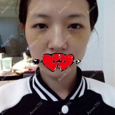 金华亚美胡华兵祛眼袋术后第6天效果图 金华亚美胡华兵祛眼袋术后第6天效果图
