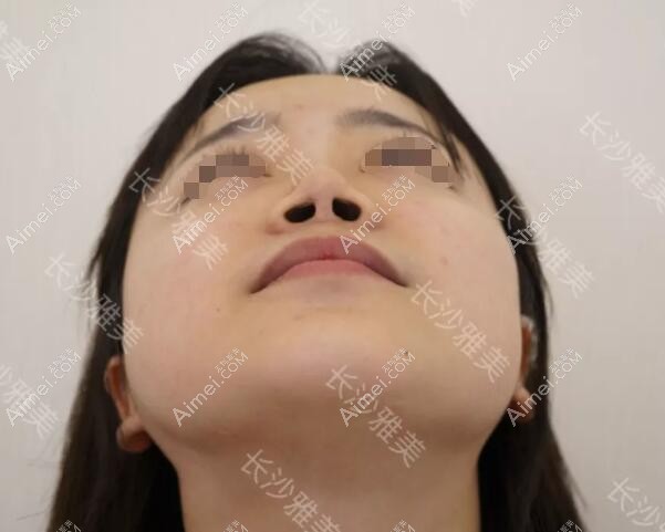隆鼻失败出现鼻头挛缩变形 隆鼻失败出现鼻头挛缩变形