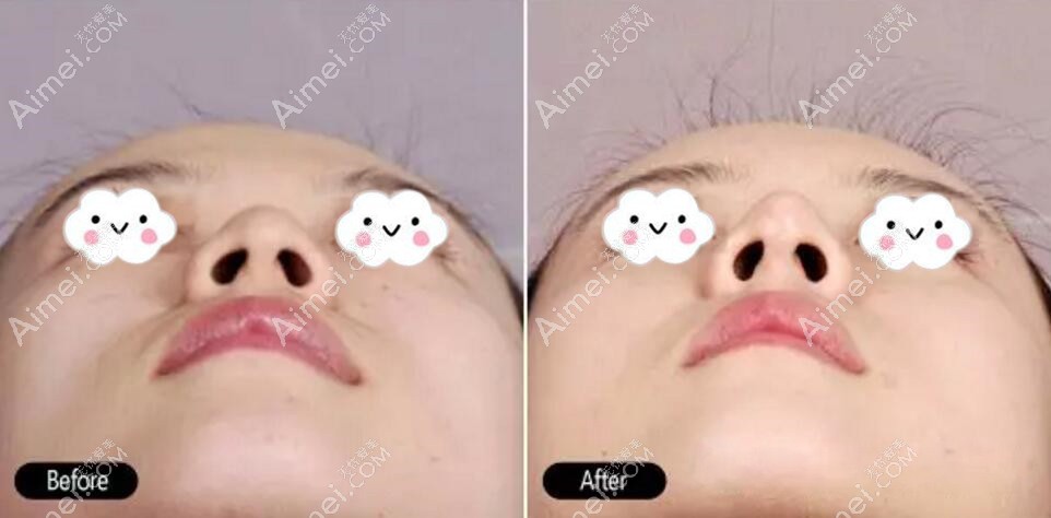 鼻综合术后鼻头鼻尖变化对比图 鼻综合术后鼻头鼻尖变化对比图