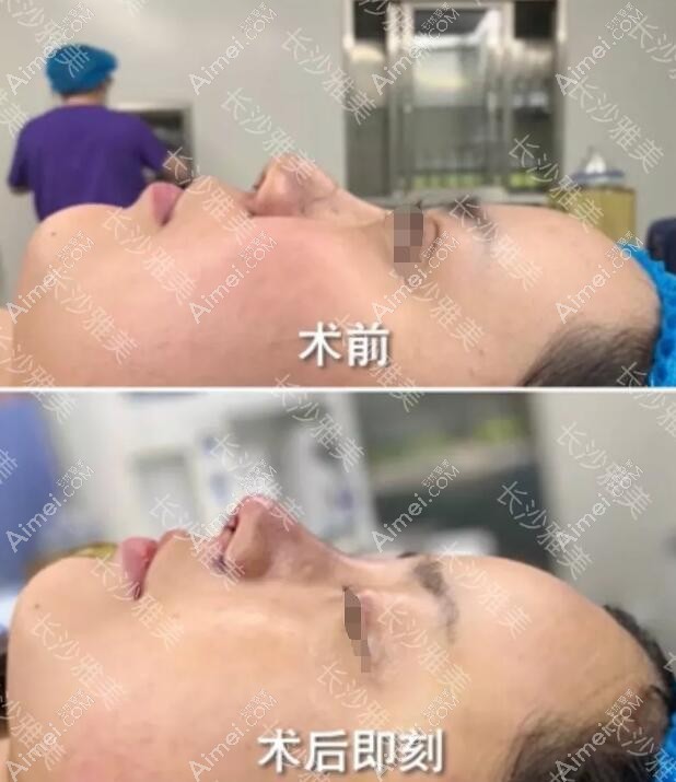 自体肋软骨+膨体鼻修复手术前后即刻对比照 自体肋软骨+膨体鼻修复手术前后即刻对比照