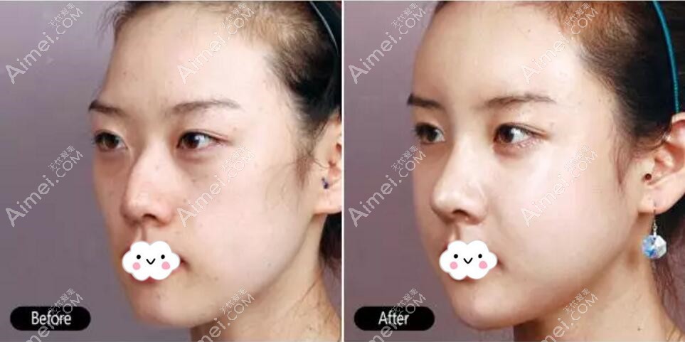 韶关涵美驼峰鼻矫正术前术后对比图 韶关涵美驼峰鼻矫正术前术后对比图