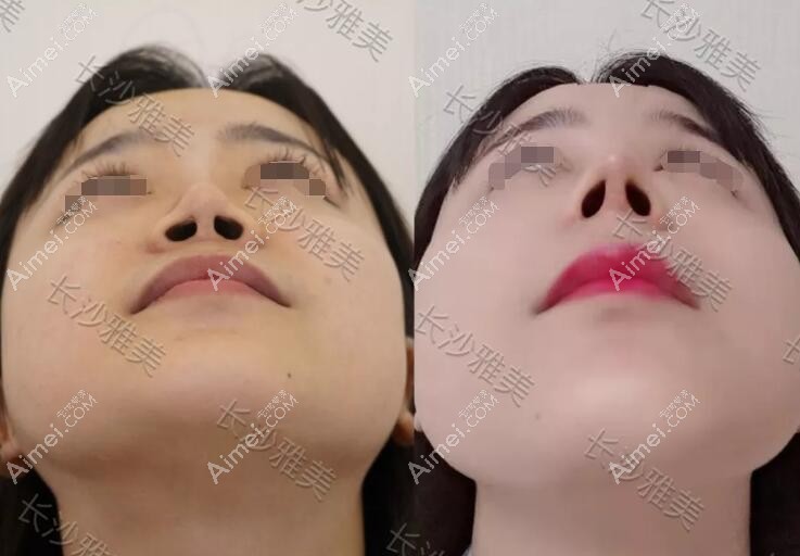 在长沙雅美做鼻修复术前术后对比 在长沙雅美做鼻修复术前术后对比