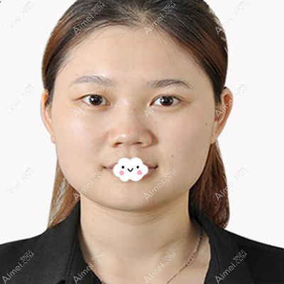 鼻综合术前照片