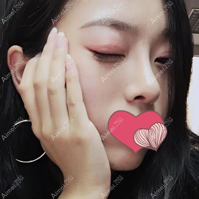 硅胶隆鼻2个月的效果图 硅胶隆鼻2个月的效果图