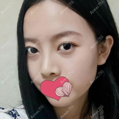 假体隆鼻一个月已经定型 假体隆鼻一个月已经定型