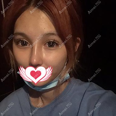 在呼和浩特华医做隆鼻手术术后半个月效果分享 在呼和浩特华医做隆鼻手术术后半个月效果分享