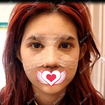 在呼和浩特华医做肋骨鼻综合术后照片 在呼和浩特华医做肋骨鼻综合术后照片