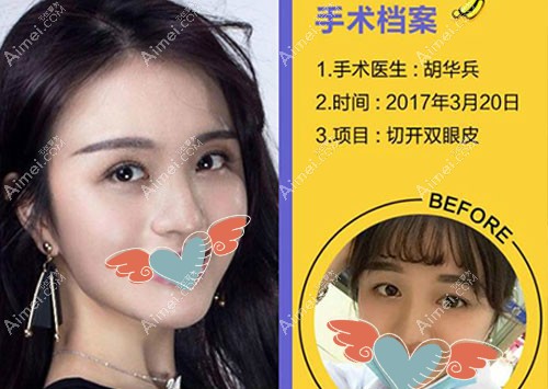 金华亚美胡华兵院长切开双眼皮案例 金华亚美胡华兵院长切开双眼皮案例