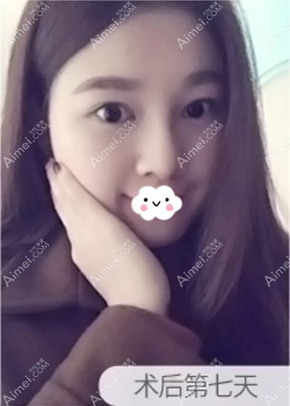 珠海爱思特鼻综合隆鼻术后7天恢复效果 珠海爱思特鼻综合隆鼻术后7天恢复效果