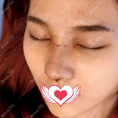 在华医整形做鼻综合术后4天鼻子纱布取了 在华医整形做鼻综合术后4天鼻子纱布取了