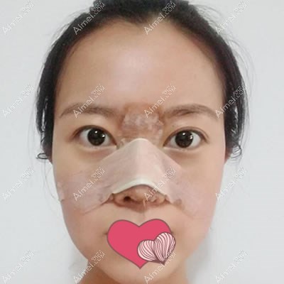 硅胶隆鼻第7天拆线,笑的时候有点僵硬 硅胶隆鼻第7天拆线,笑的时候有点僵硬