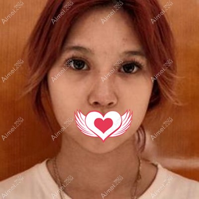 宋耀宗医生为我做鼻子术后7天拆线 宋耀宗医生为我做鼻子术后7天拆线