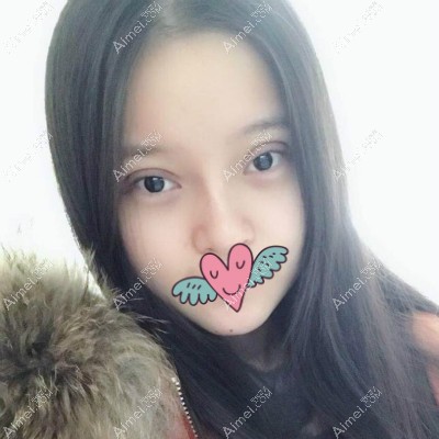 我去杭州格莱美找张霞飞院长割双眼皮后7天恢复图片 我去杭州格莱美找张霞飞院长割双眼皮后7天恢复图片