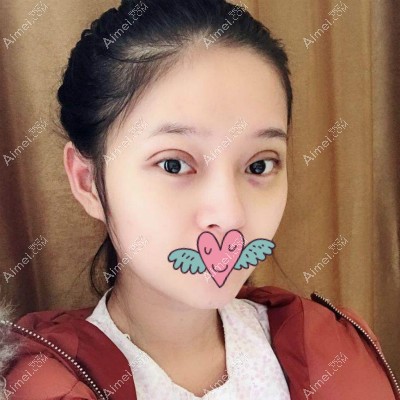 杭州格莱美张霞飞院长给我割双眼皮3天的照片 杭州格莱美张霞飞院长给我割双眼皮3天的照片