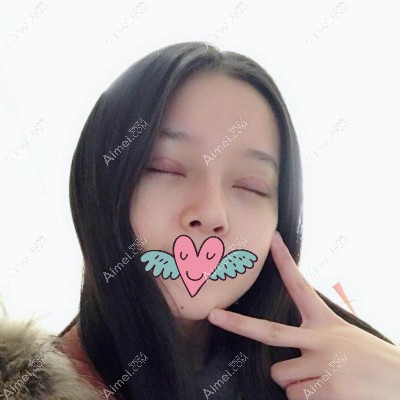 我去杭州格莱美割完双眼皮15天的照片 我去杭州格莱美割完双眼皮15天的照片