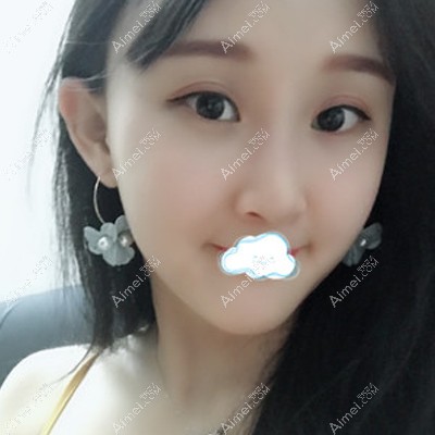 做自体脂肪填充2个月后的样子 做自体脂肪填充2个月后的样子