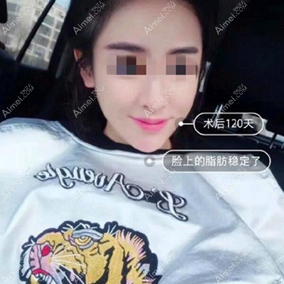 脂肪填充4个月 脂肪填充4个月