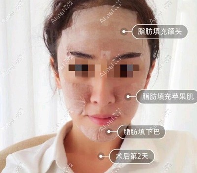 脂肪填充术后2天 脂肪填充术后2天