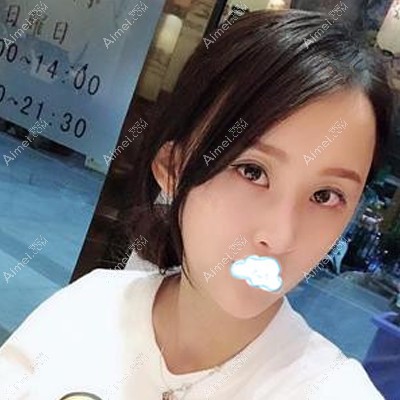 在南宁梦想做脂肪填充面部术后2个月脸型变好看 在南宁梦想做脂肪填充面部术后2个月脸型变好看