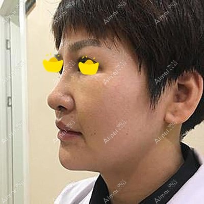 隆鼻7天后到院拆线 隆鼻7天后到院拆线