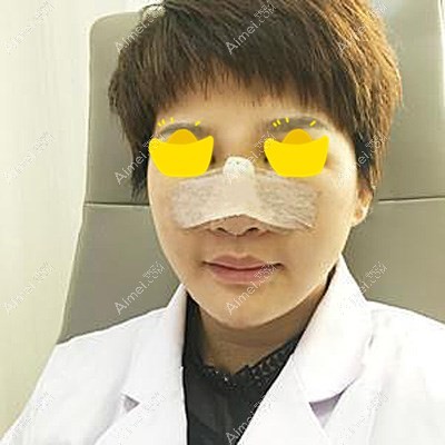 刚刚做完射极峰膨体隆鼻后的样子 刚刚做完射极峰膨体隆鼻后的样子