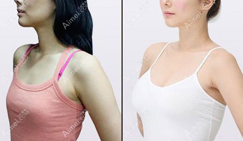 假体隆胸包膜挛缩修复案例 假体隆胸包膜挛缩修复案例