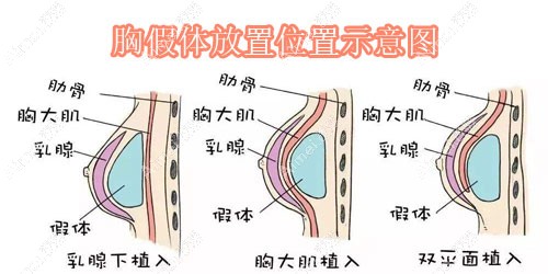 胸假体放置位置示意图 胸假体放置位置示意图