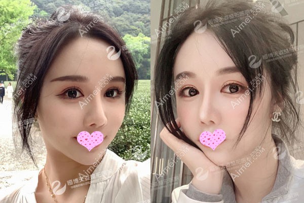 不知成都哪家脂肪填充好,成都天姿案例 不知成都哪家脂肪填充好,成都天姿案例