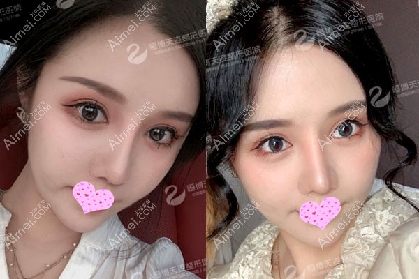 成都天姿医美自体脂肪面部填充术后2个月恢复效果图 成都天姿医美自体脂肪面部填充术后2个月恢复效果图