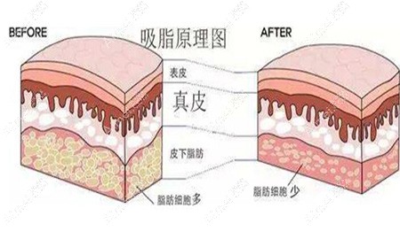 吸脂原理示意图 吸脂原理示意图