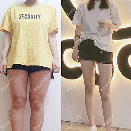 在杭州静港做大腿环吸3000ml效果对比照 在杭州静港做大腿环吸3000ml效果对比照
